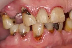 cervical