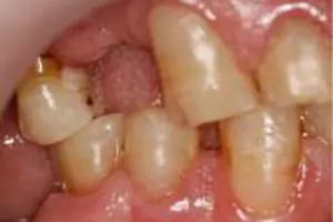 cervical2
