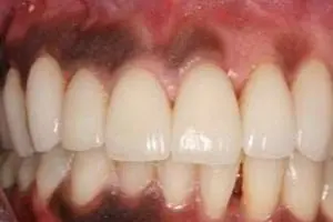 depigmentation