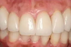 depigmentation1