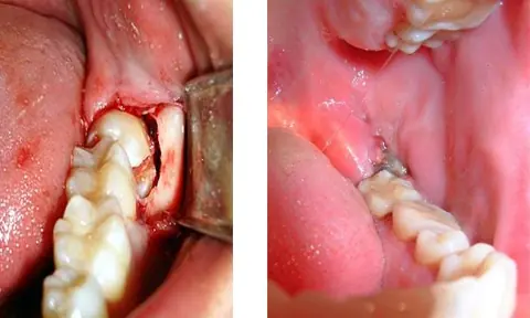 impaction5