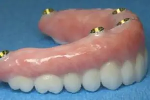 implant-four2