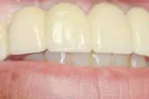 Implant1