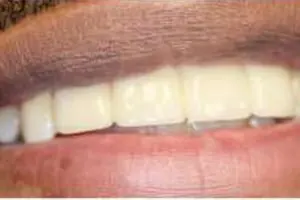 Implant2
