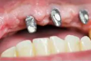 Implant3