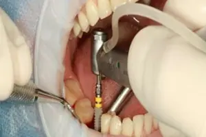Implant4