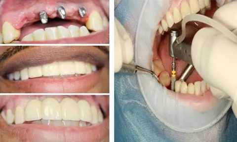 Implant5