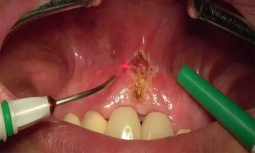 laser_dentistry1