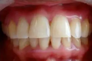 midline2