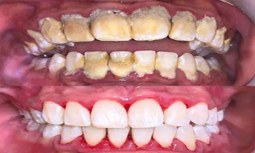 periodontics5