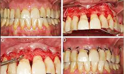 periodontics7