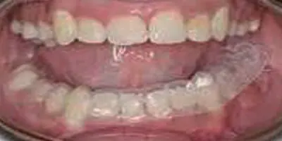 Retainers6