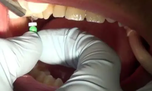 rootcanal1