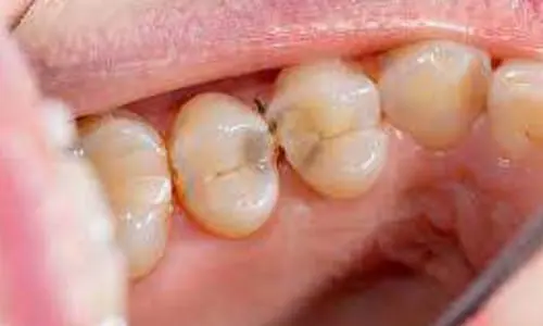 rootcanal2