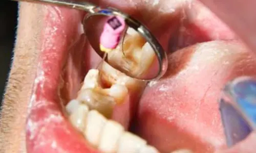 rootcanal3