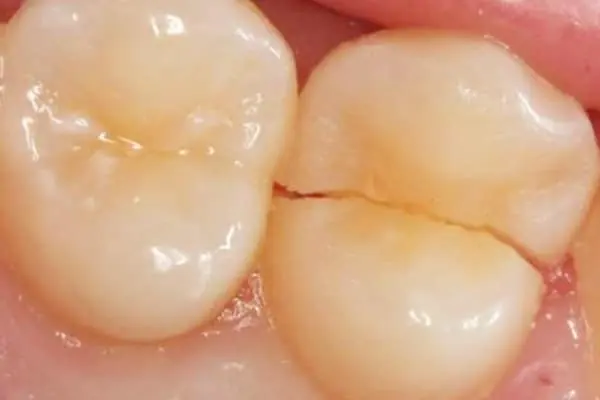 tooth_fracture