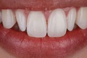 veneer